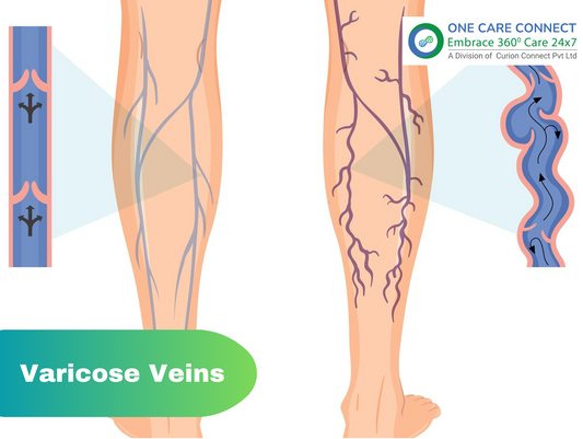 Varicose Veins: Causes, Symptoms & Prevention Tips for Healthy Legs